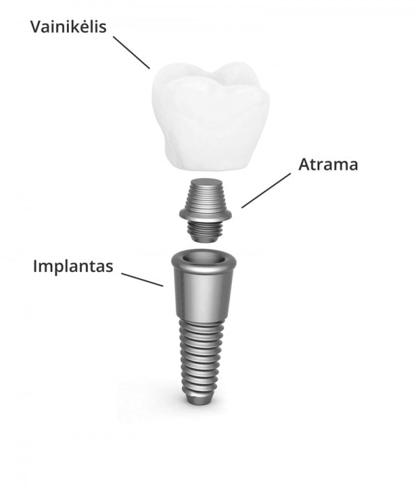 Implantas-600x700
