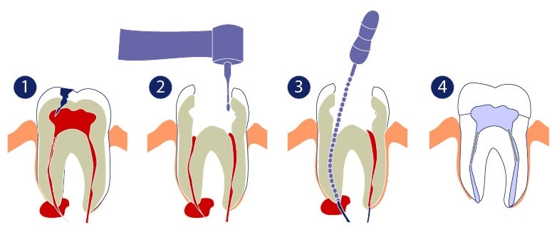 rootcanalillustrationmolar